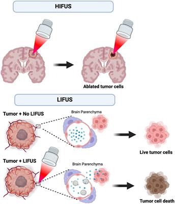 Focused ultrasound as a treatment modality for gliomas